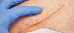 I had a surgery, now what?